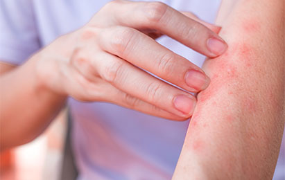 Eczema