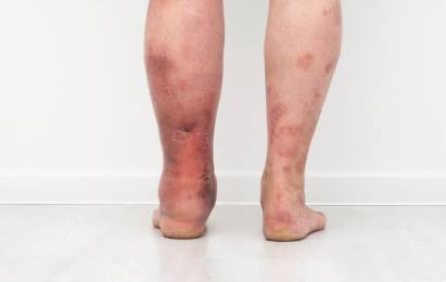 Leucoderma