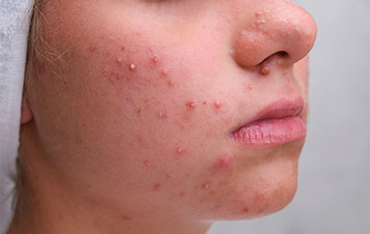 Acne & Pimples