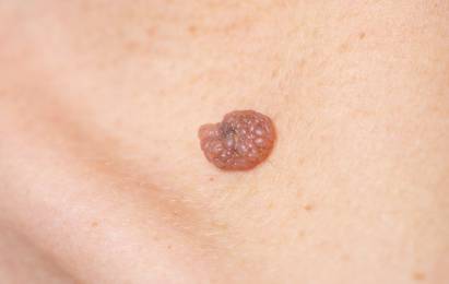 Skin Cancers
