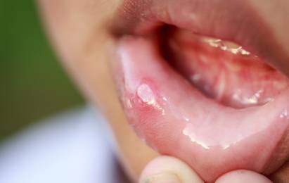 ulcers