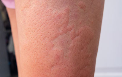 Urticaria (Hives) & Skin Allergies